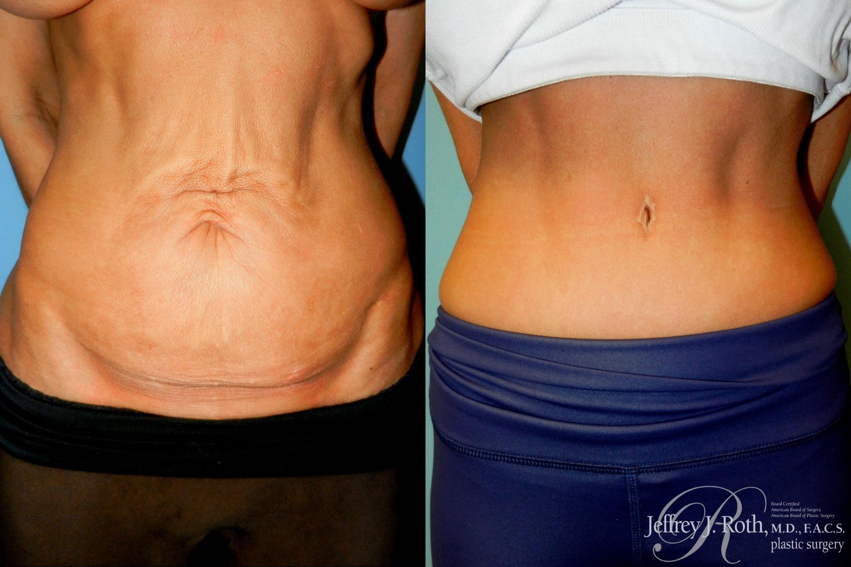 Tummy Tuck result at Jeffrey J. Roth, MD Plastic Surgery