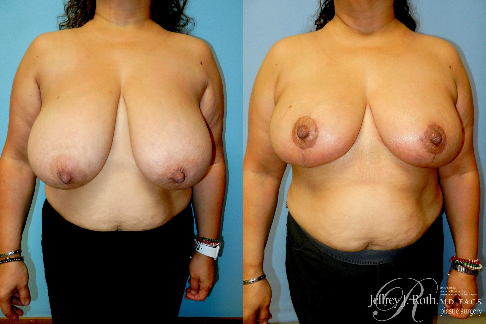 Breast Reduction result at Jeffrey J. Roth, MD Plastic Surgery