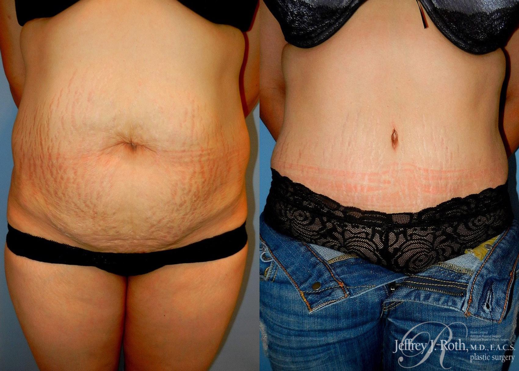 Tummy Tuck result at Jeffrey J. Roth, MD Plastic Surgery