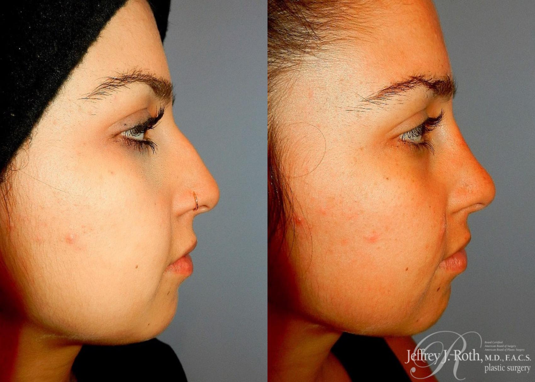 Rhinoplasty result at Jeffrey J. Roth, MD Plastic Surgery