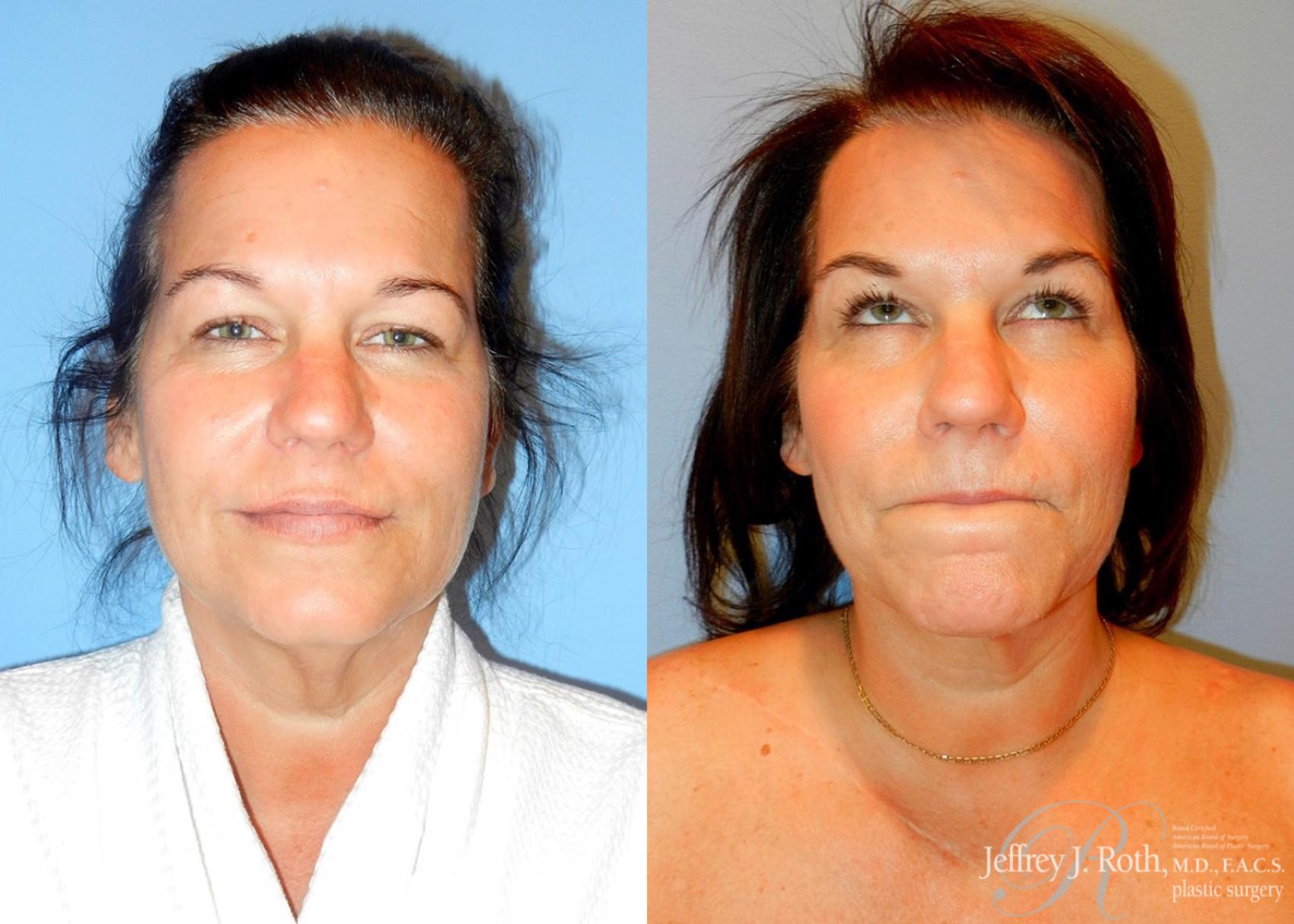 Liposuction result at Jeffrey J. Roth, MD Plastic Surgery