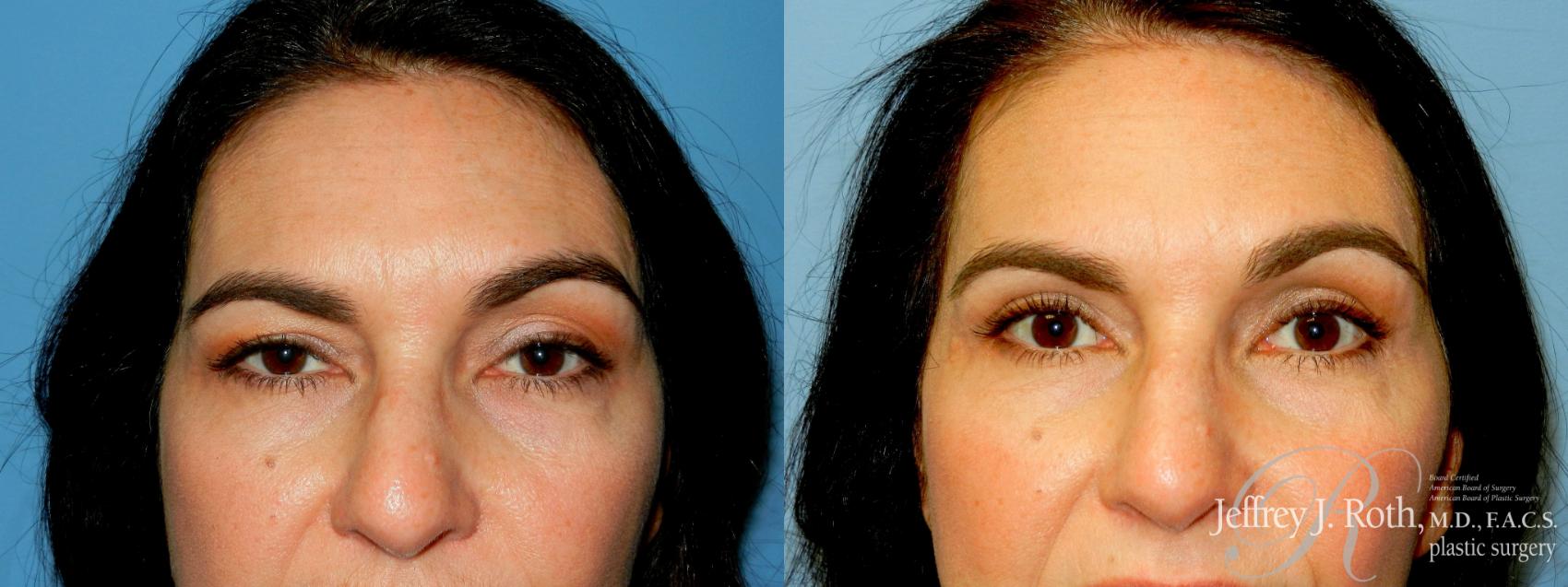 Blepharoplasty result at Jeffrey J. Roth, MD Plastic Surgery