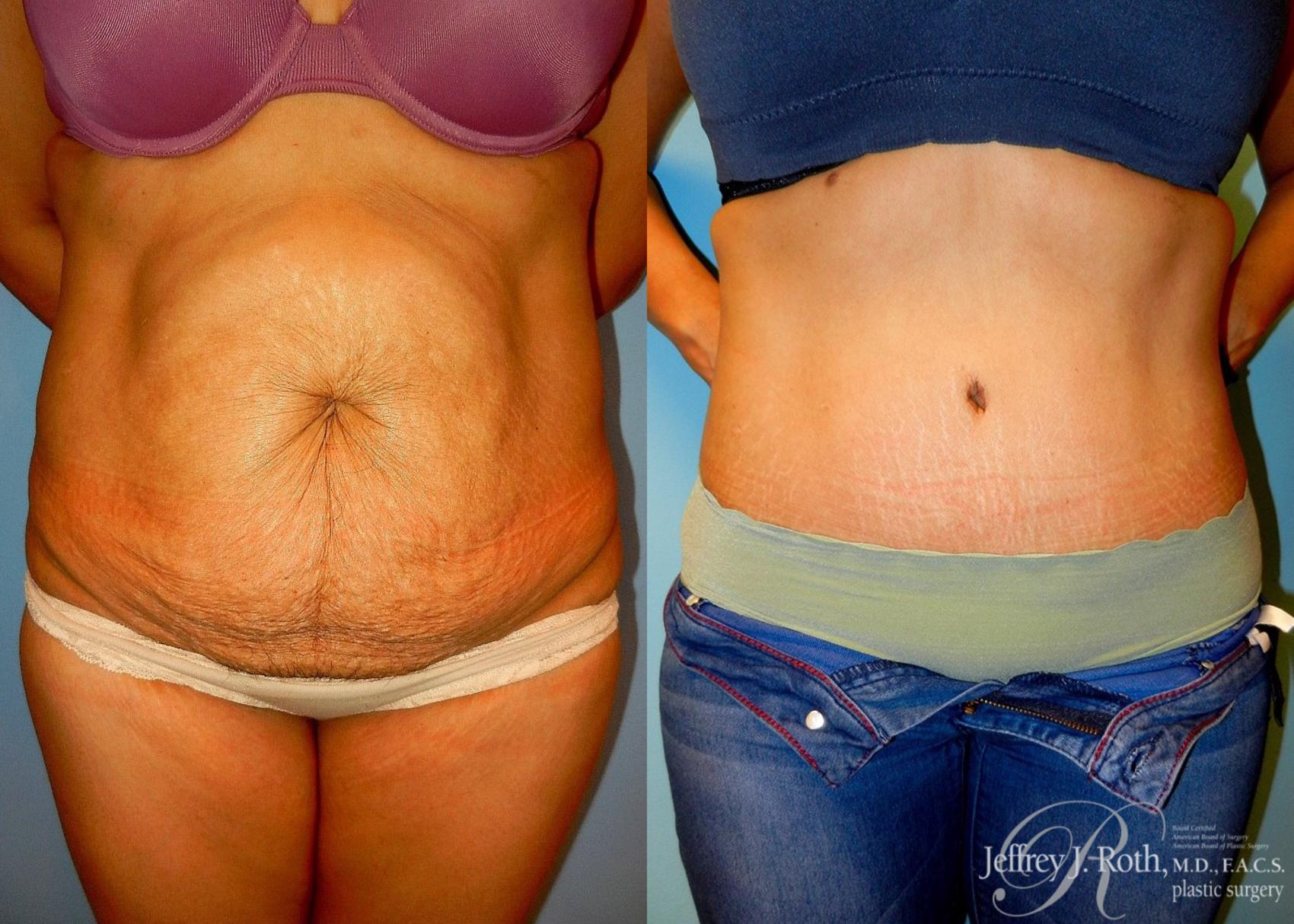 Mommy Makeover result at Jeffrey J. Roth, MD Plastic Surgery