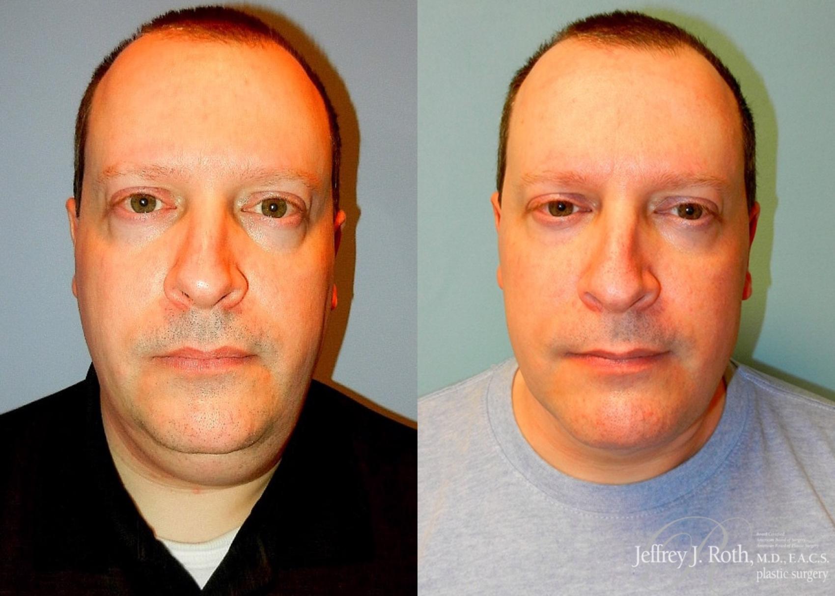 Liposuction result at Jeffrey J. Roth, MD Plastic Surgery