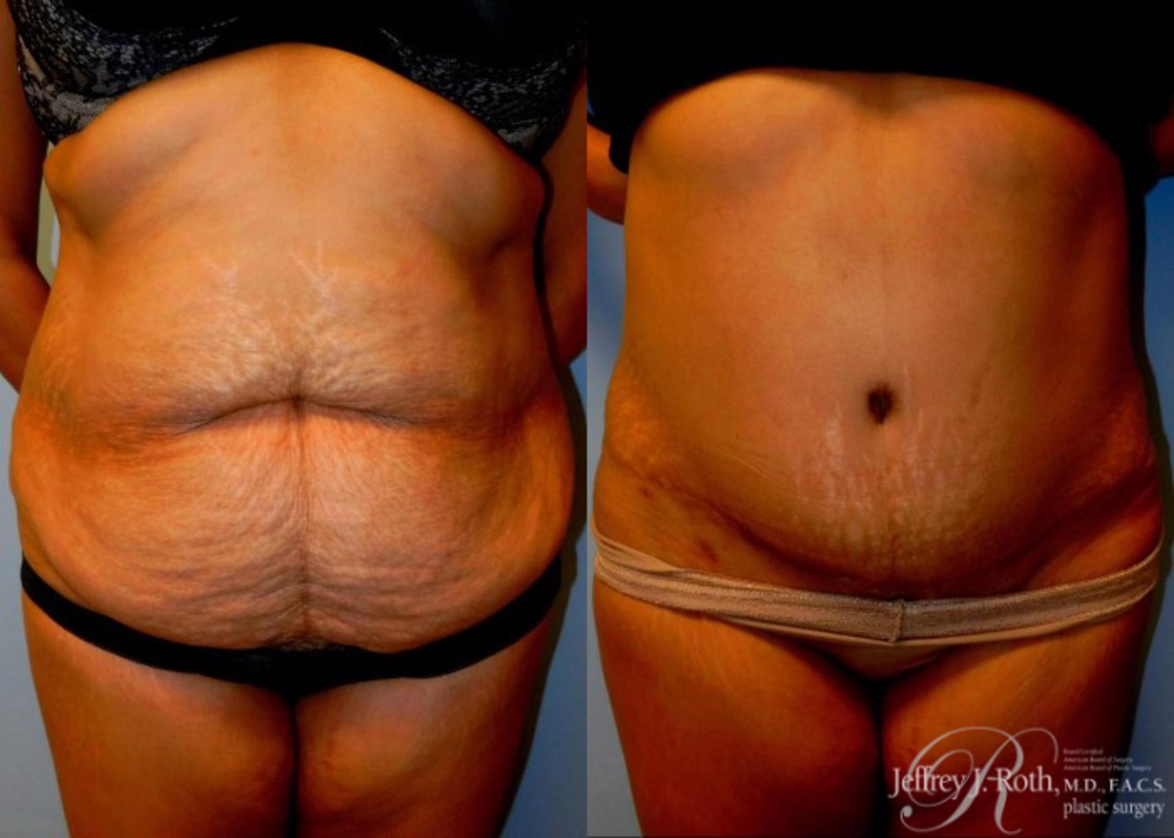 Tummy Tuck result at Jeffrey J. Roth, MD Plastic Surgery