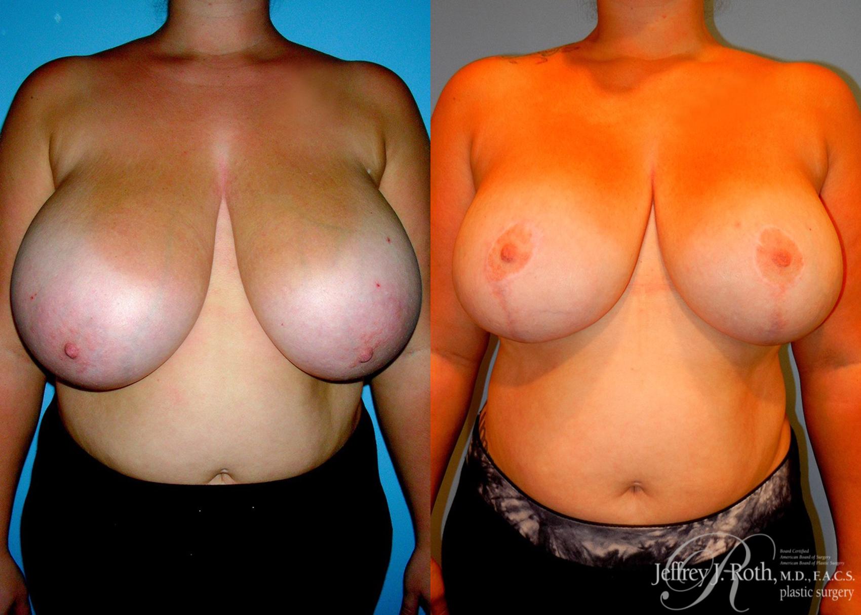 Breast Reduction result at Jeffrey J. Roth, MD Plastic Surgery