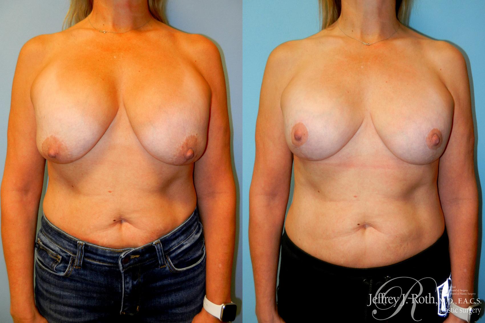Implant Revision result at Jeffrey J. Roth, MD Plastic Surgery