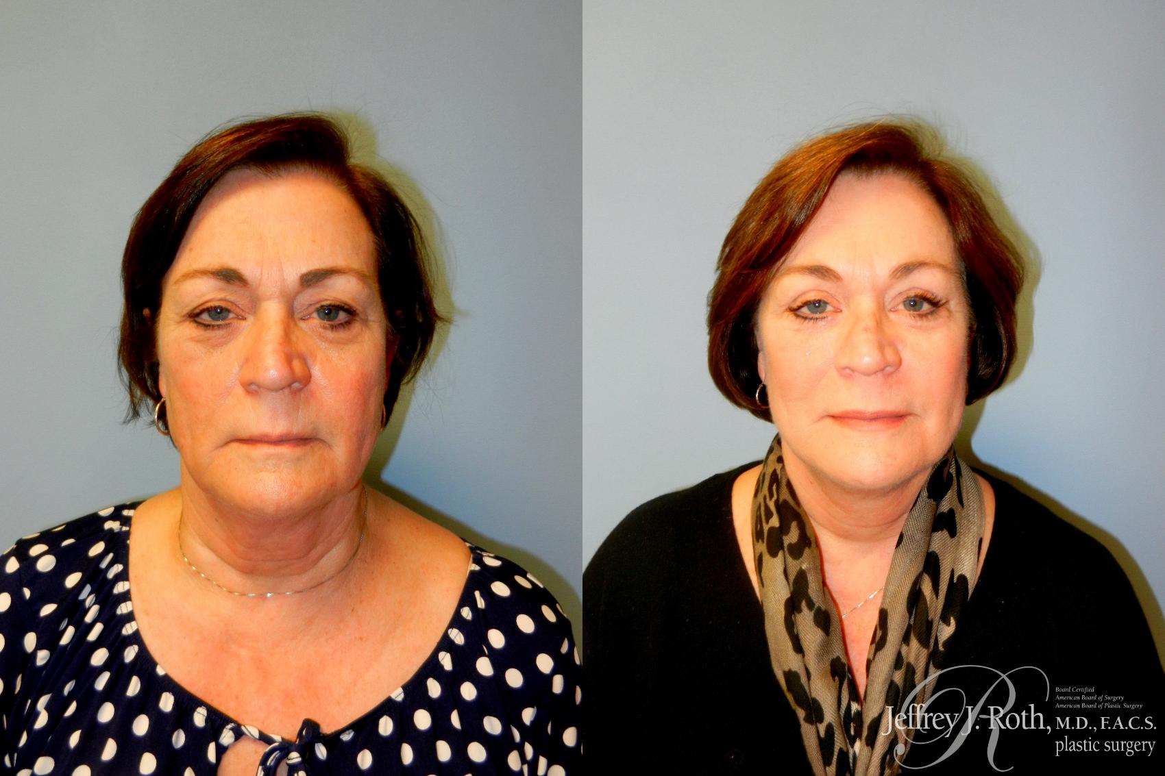 Facelift result at Jeffrey J. Roth, MD Plastic Surgery