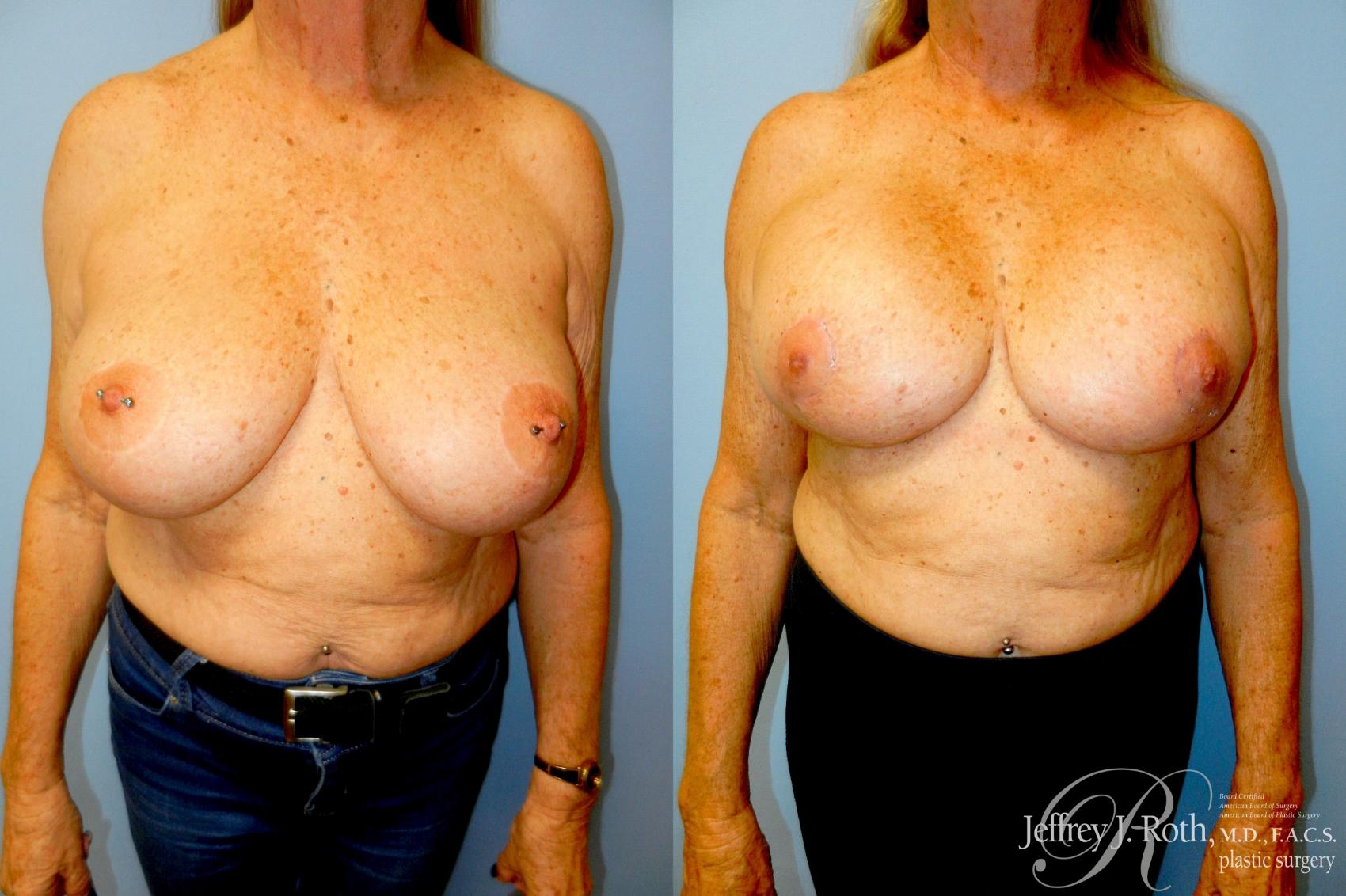 Breast Lift result at Jeffrey J. Roth, MD Plastic Surgery