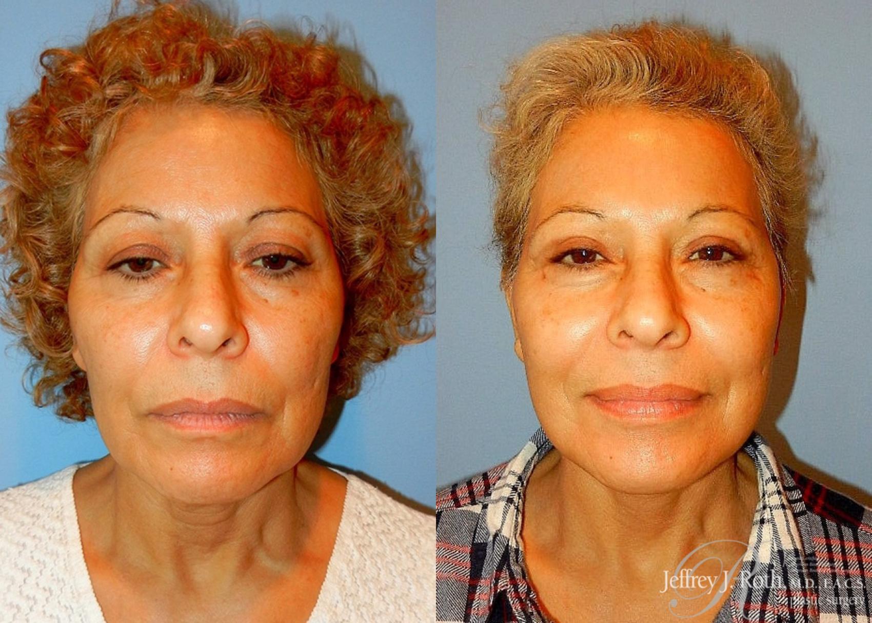 Facelift result at Jeffrey J. Roth, MD Plastic Surgery