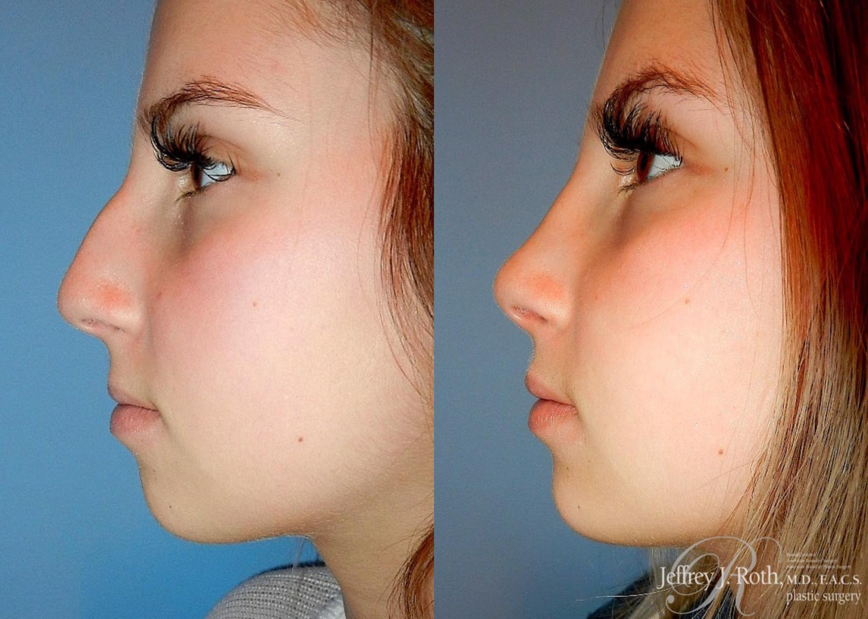 Rhinoplasty result at Jeffrey J. Roth, MD Plastic Surgery