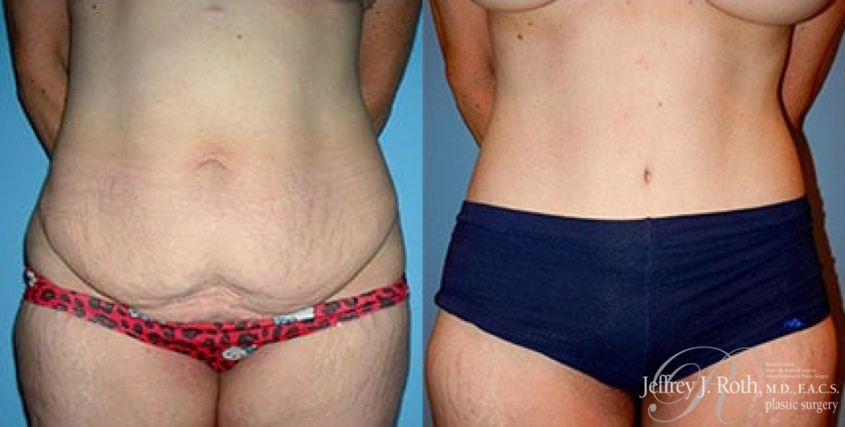 Tummy Tuck result at Jeffrey J. Roth, MD Plastic Surgery
