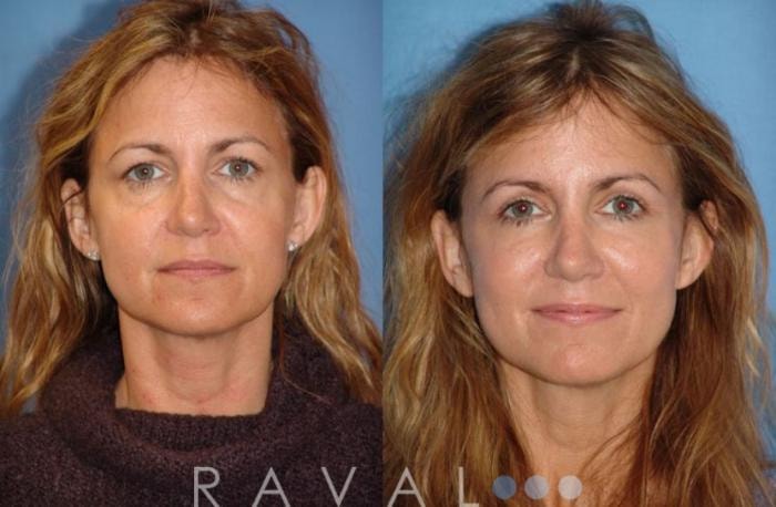 A result from Raval Facial Aesthetics