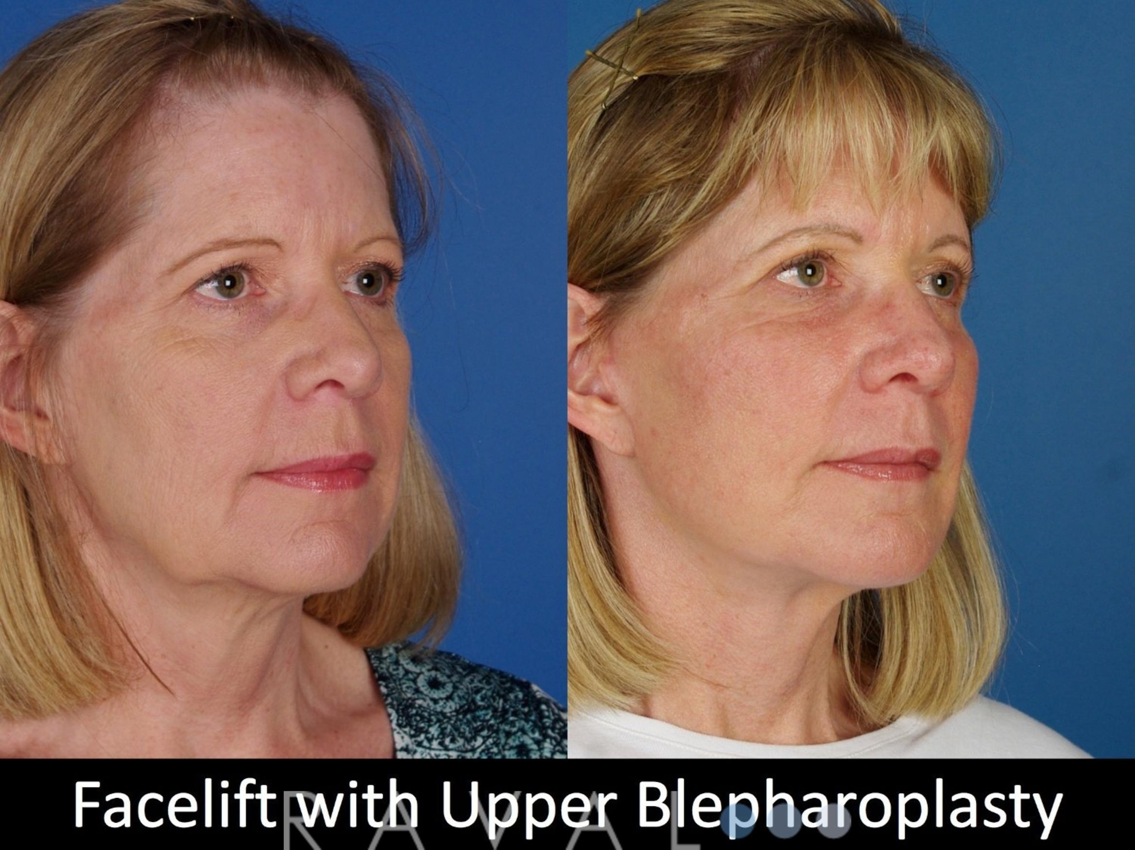 A result from Raval Facial Aesthetics