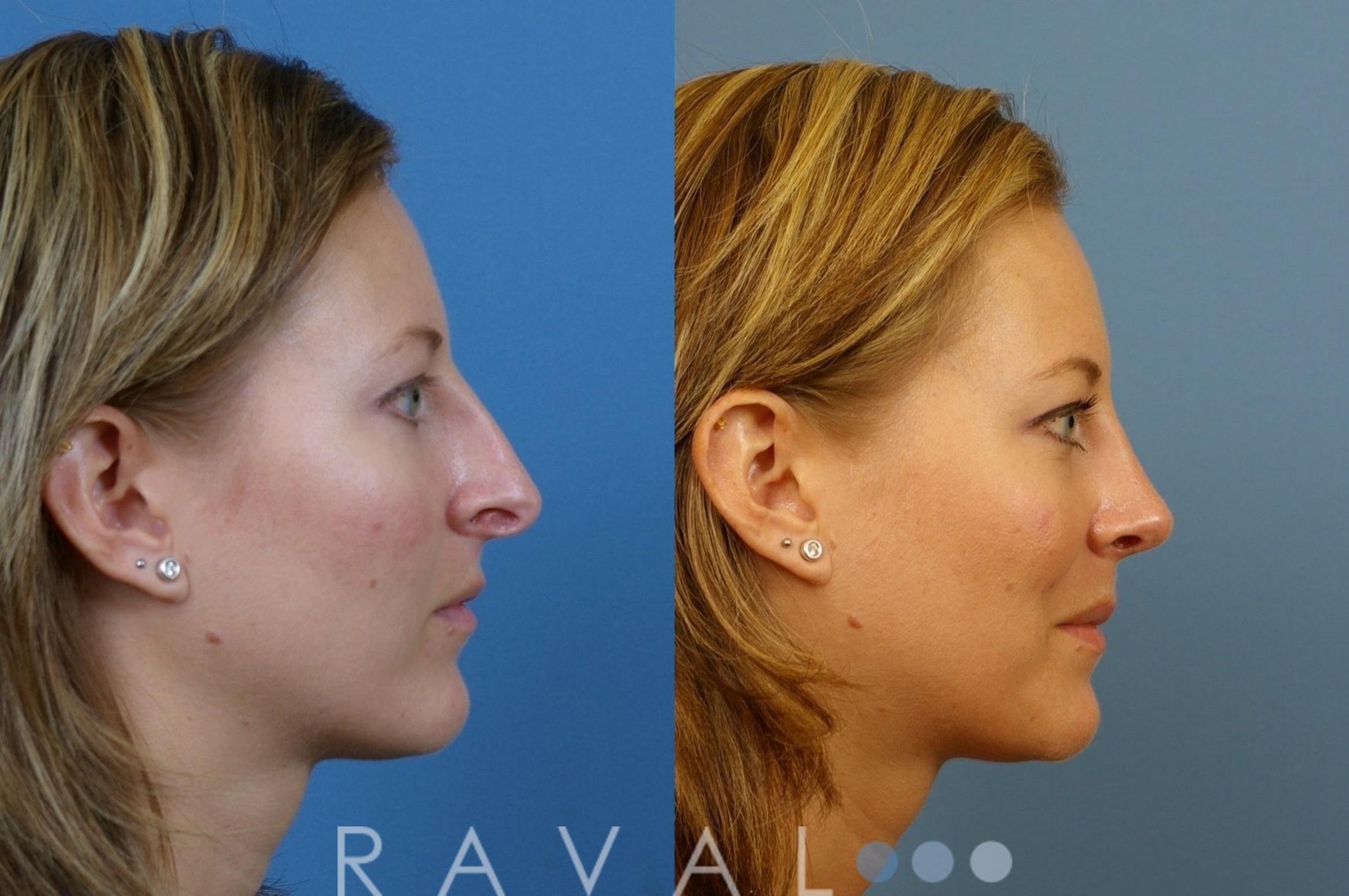 A result from Raval Facial Aesthetics