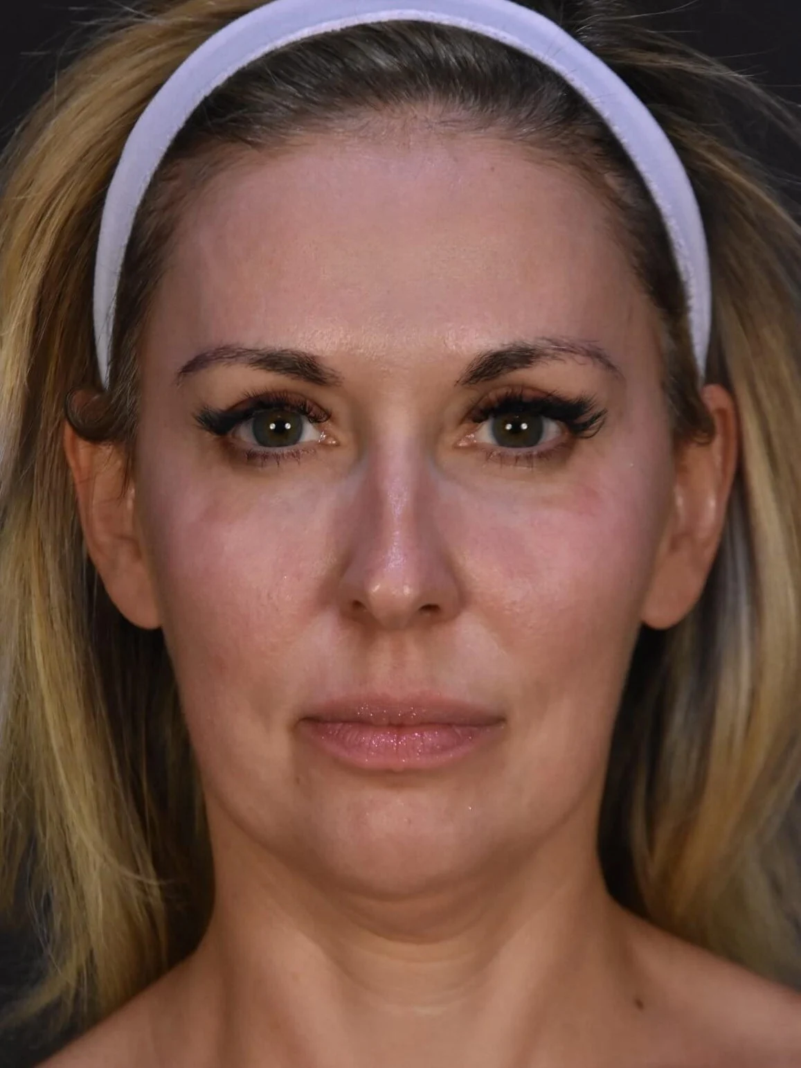 Procedure result at Plastic Surgery Vegas