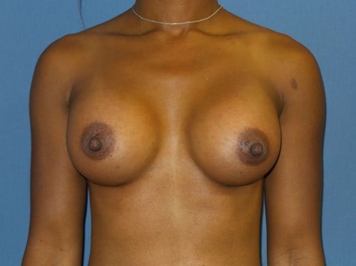 Breast Augmentation result at Plastic Surgery Vegas