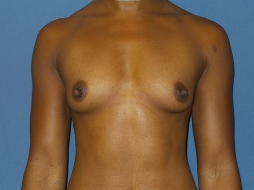 Breast Augmentation before photo