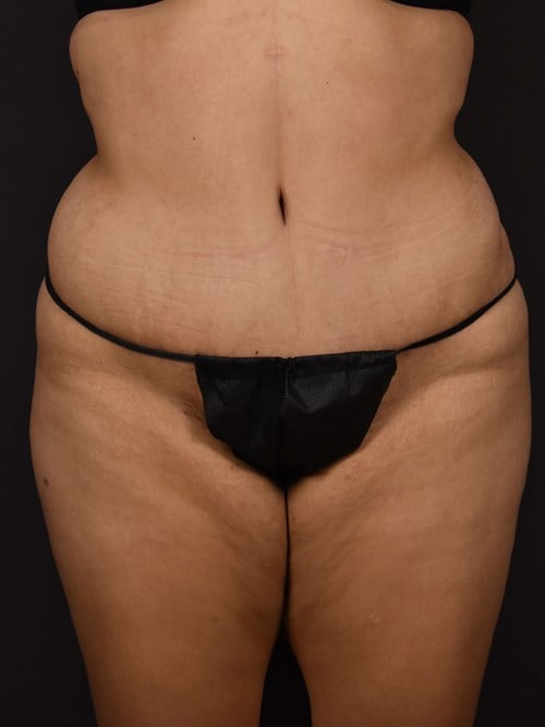 Tummy Tuck result at Plastic Surgery Vegas