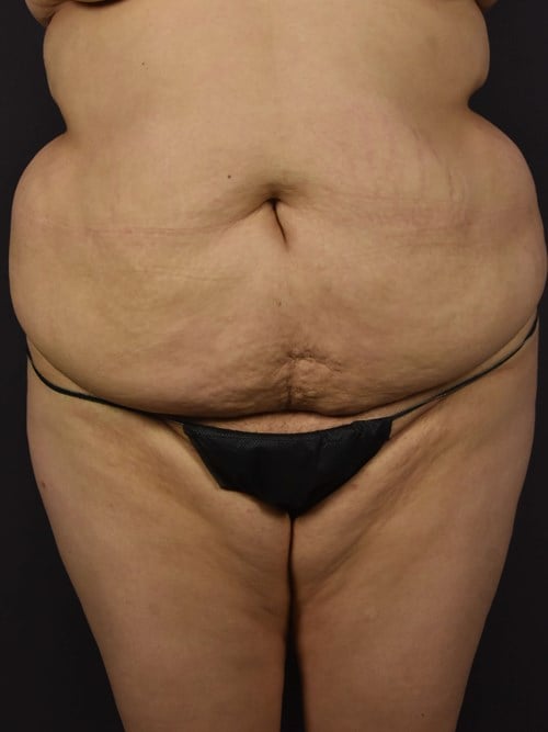 Tummy Tuck before photo