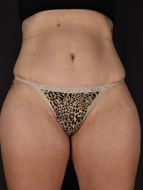 Tummy Tuck result at Plastic Surgery Vegas