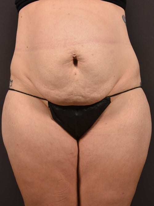 Tummy Tuck before photo