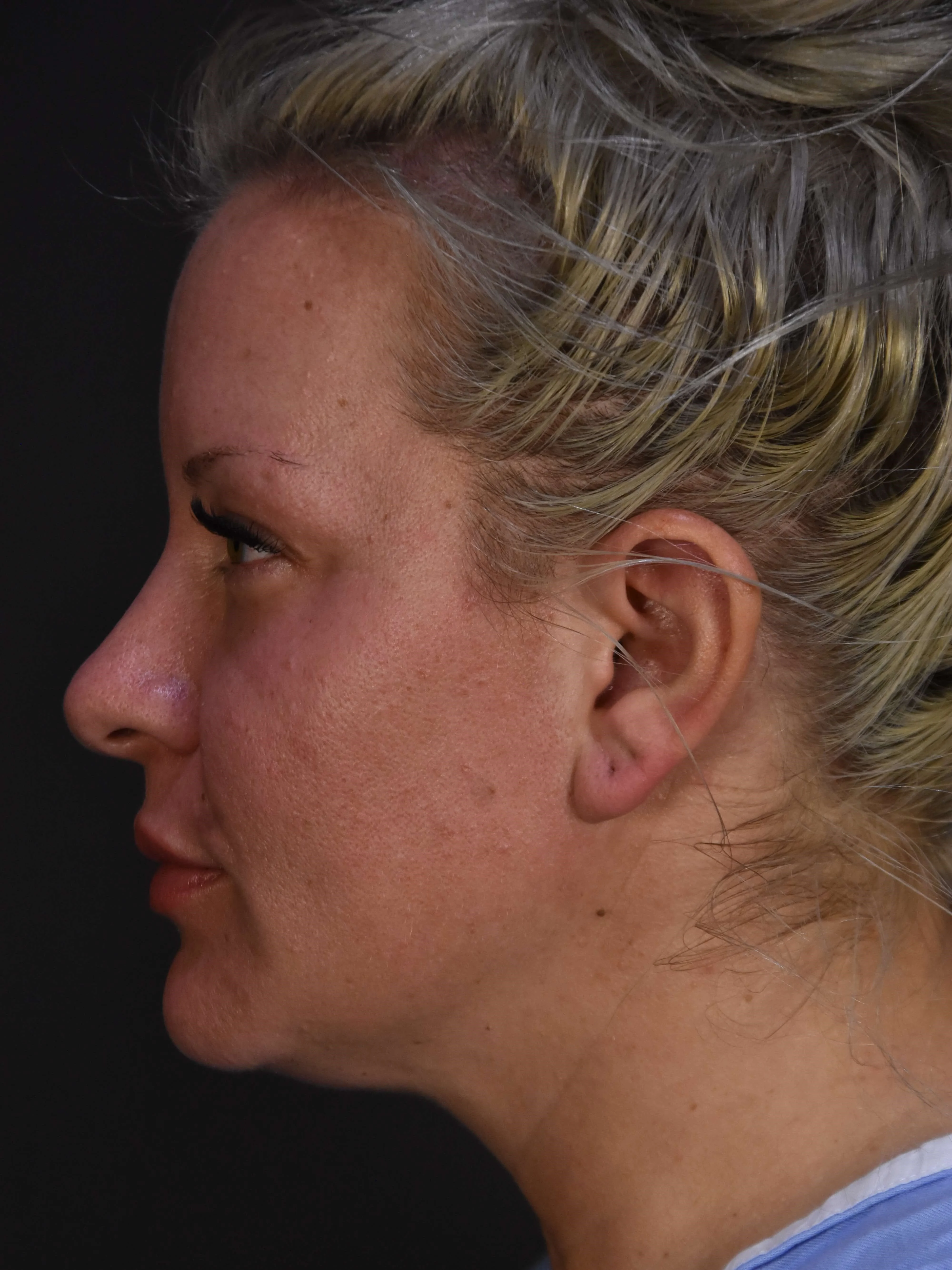 Liposuction result at Plastic Surgery Vegas
