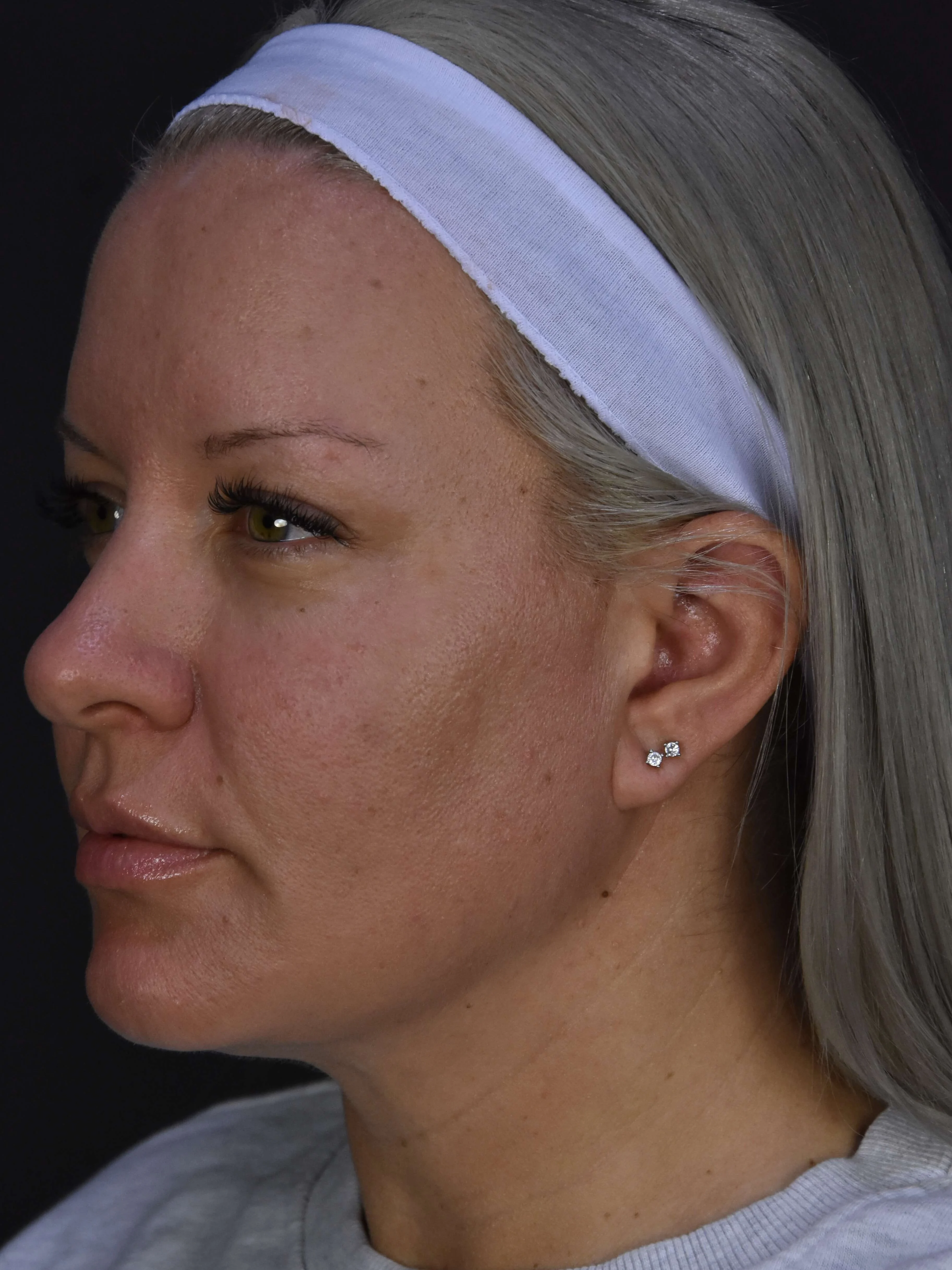 Liposuction result at Plastic Surgery Vegas