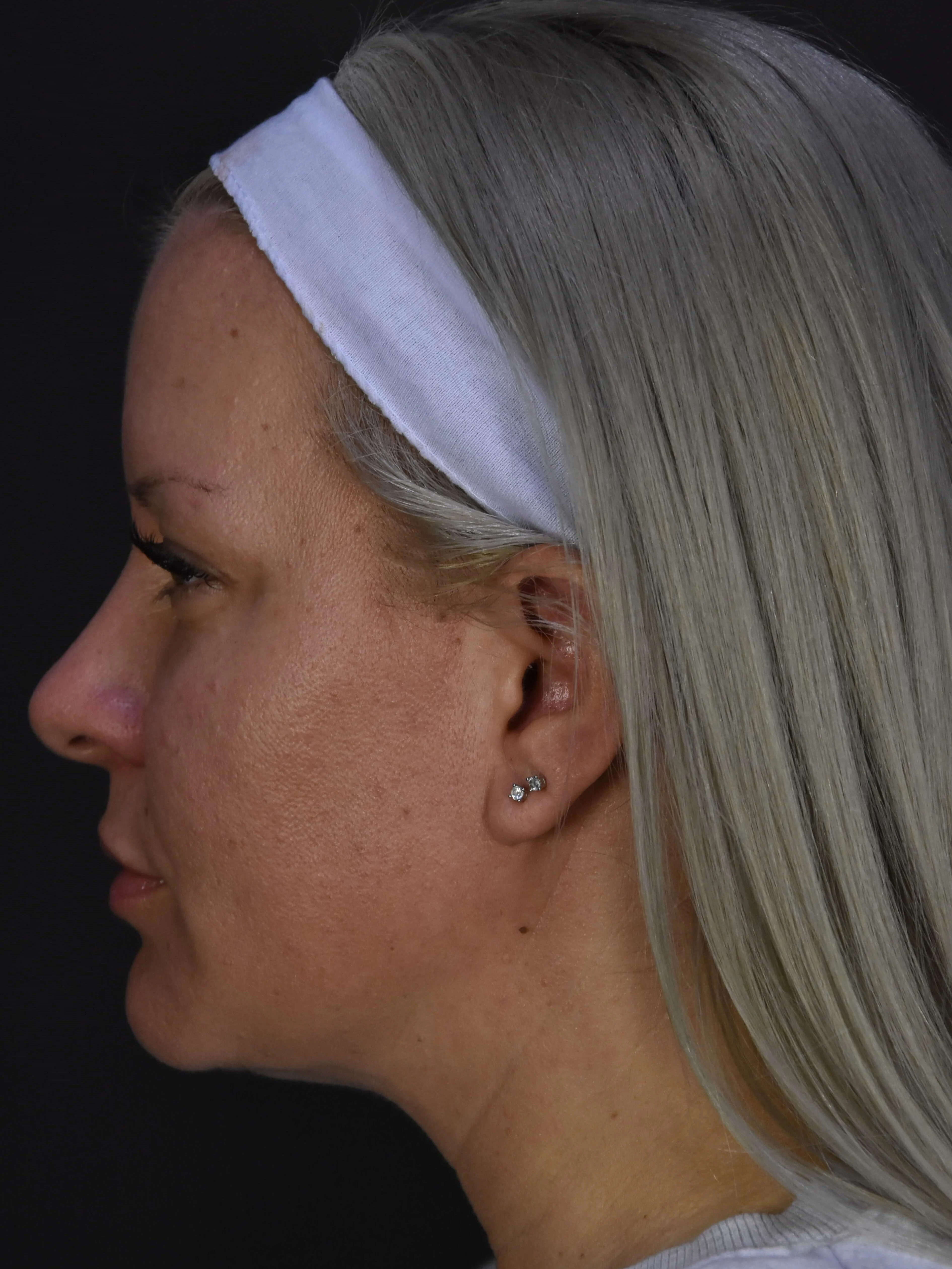 Liposuction result at Plastic Surgery Vegas