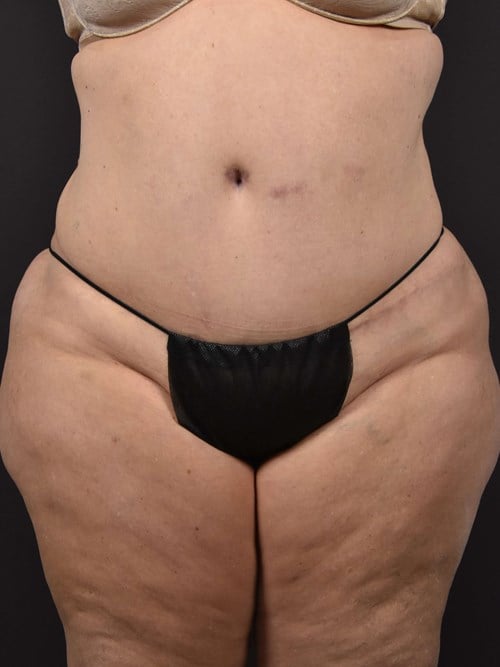 Tummy Tuck result at Plastic Surgery Vegas
