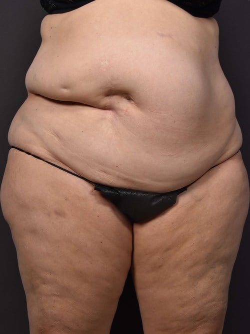Tummy Tuck before photo