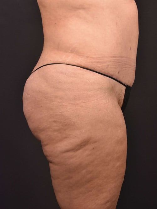 Tummy Tuck result at Plastic Surgery Vegas