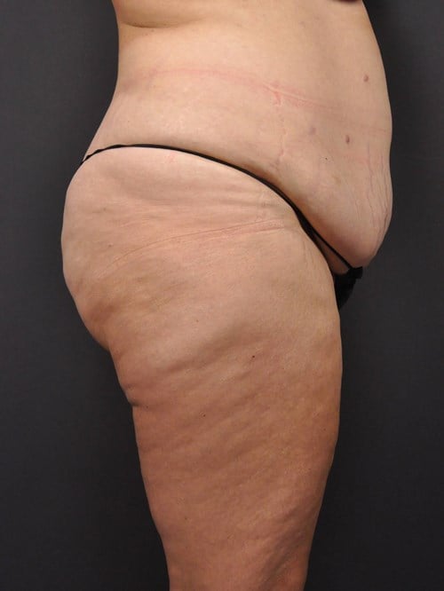 Tummy Tuck before photo