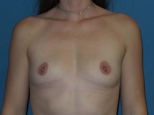 Breast Augmentation before photo