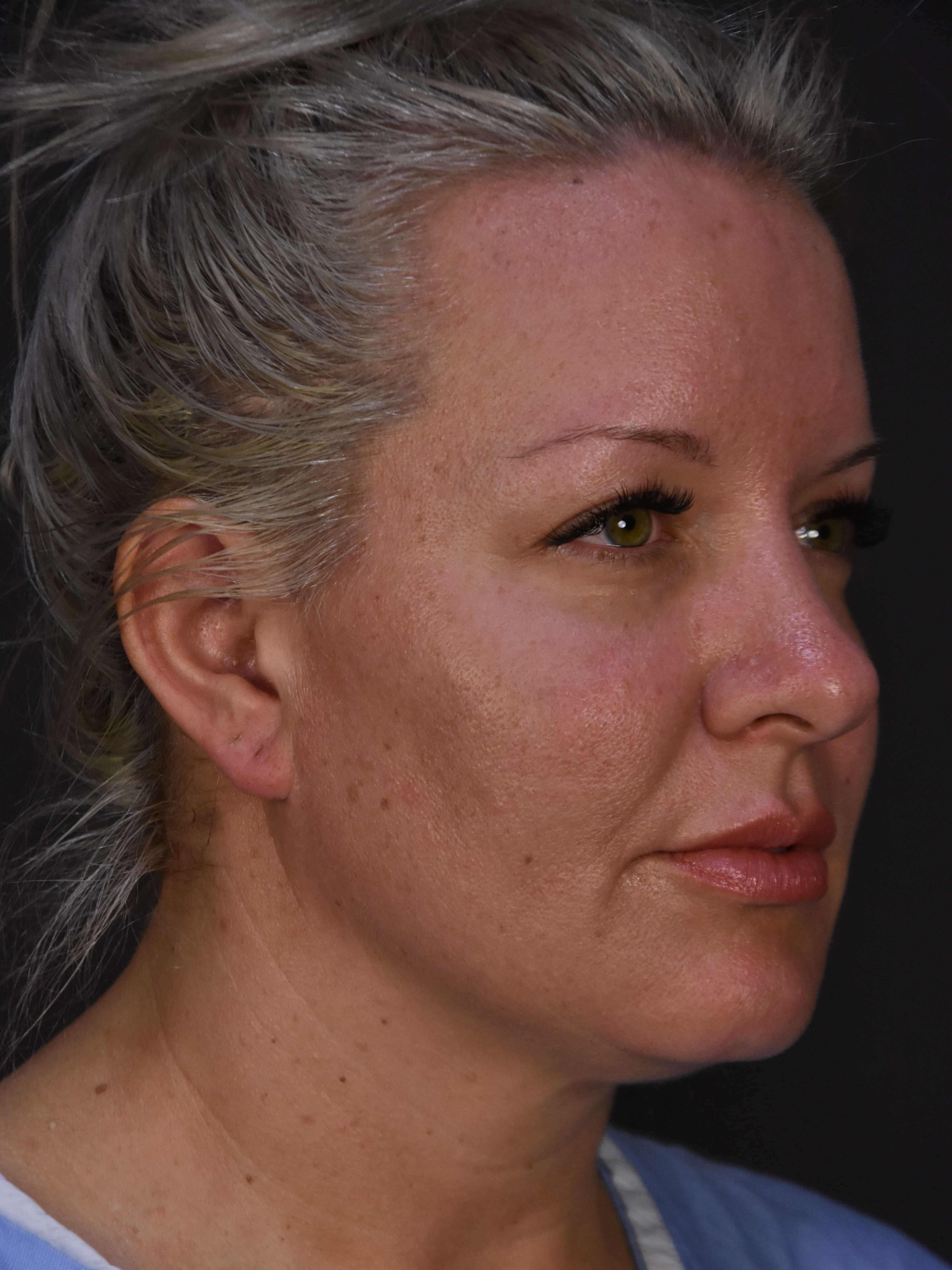 Liposuction result at Plastic Surgery Vegas