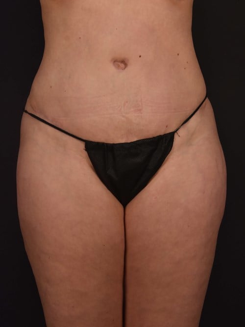 Tummy Tuck result at Plastic Surgery Vegas