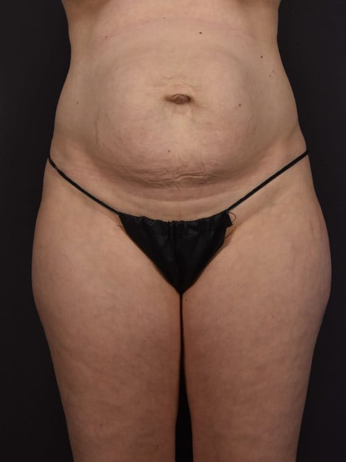 Tummy Tuck before photo