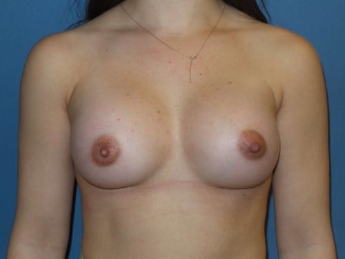 Breast Augmentation result at Plastic Surgery Vegas