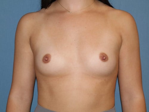 Breast Augmentation before photo