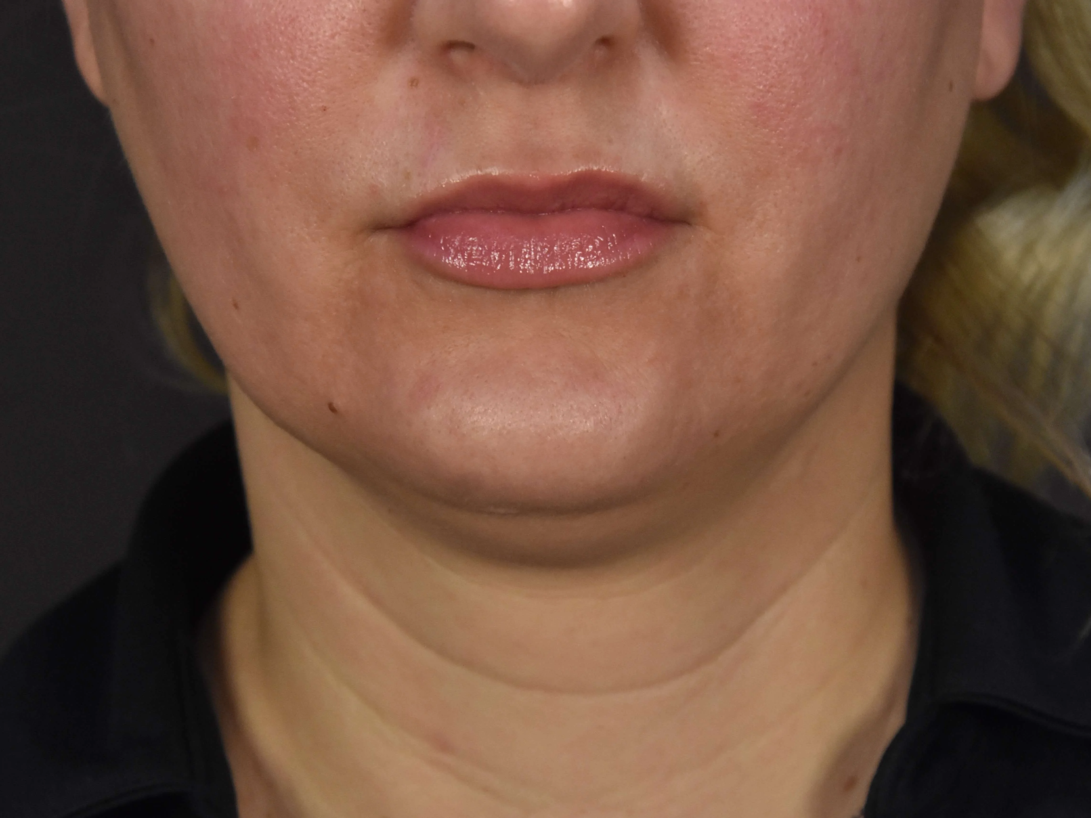 Procedure result at Plastic Surgery Vegas