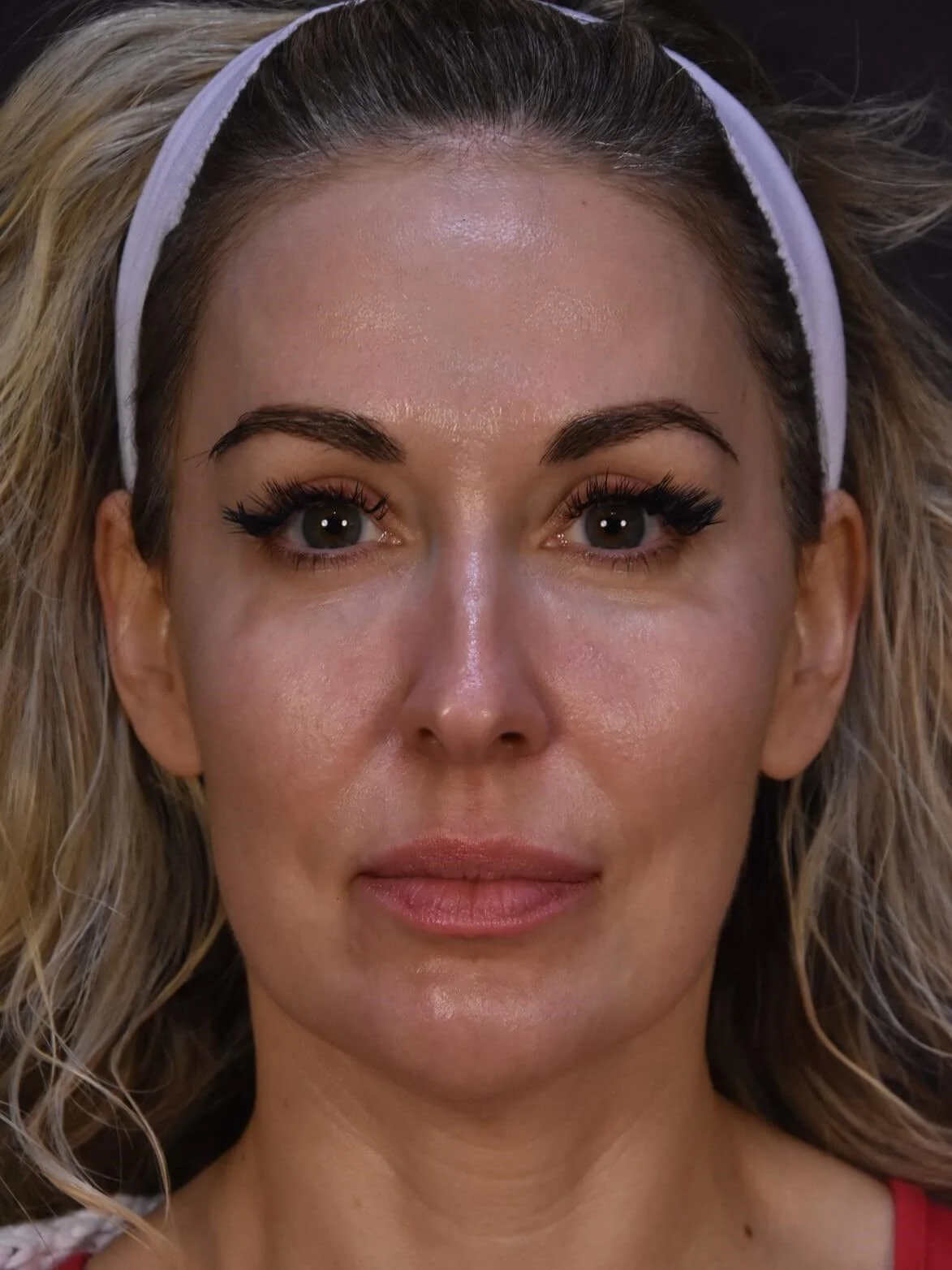 Procedure result at Plastic Surgery Vegas