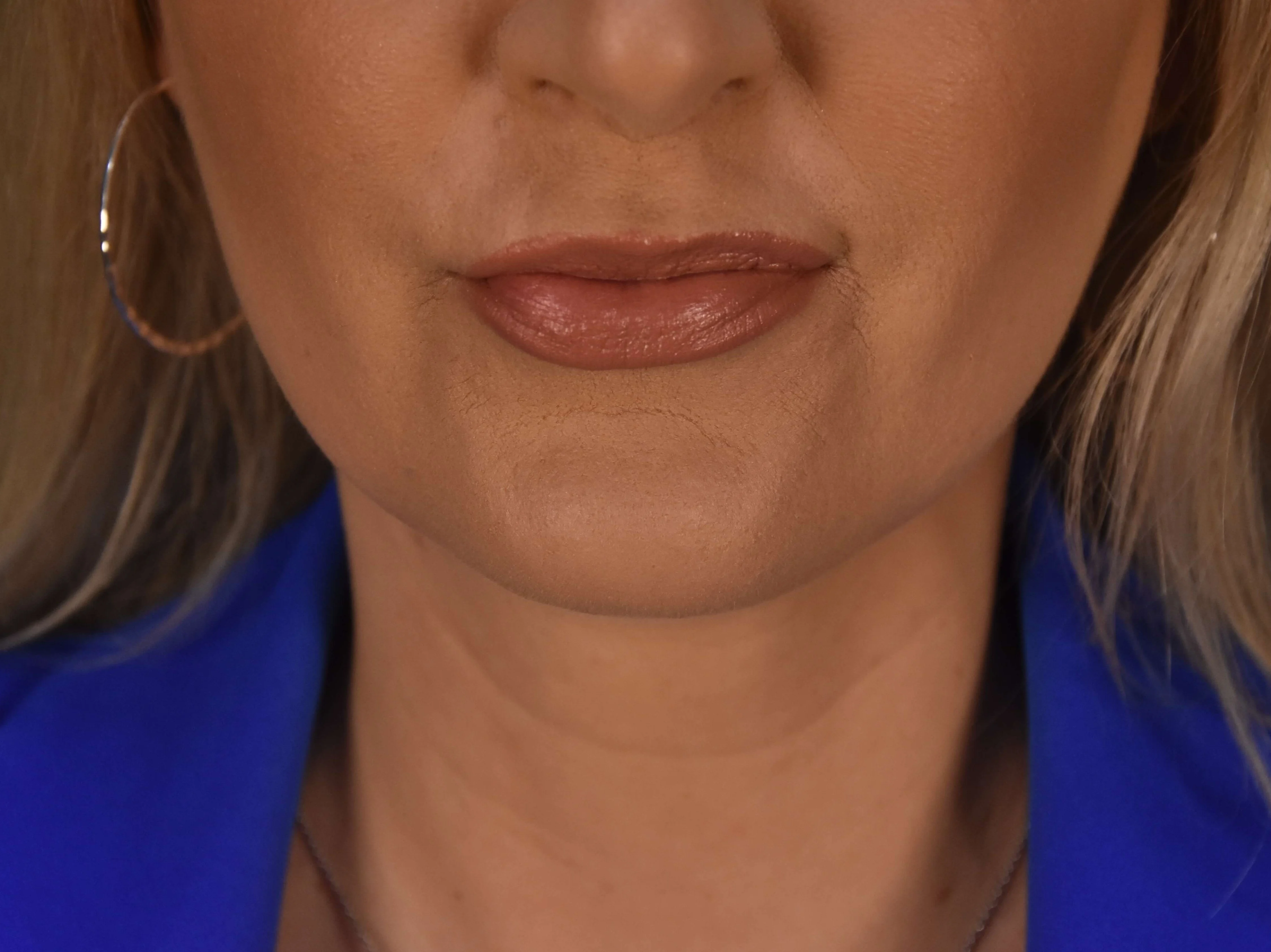 Procedure result at Plastic Surgery Vegas