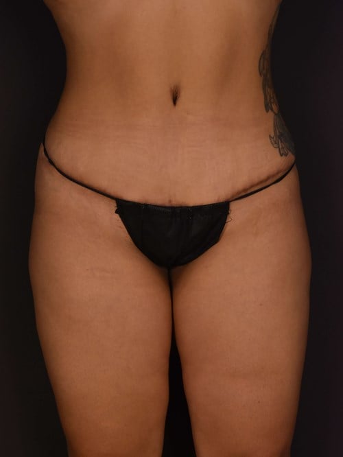 Tummy Tuck result at Plastic Surgery Vegas