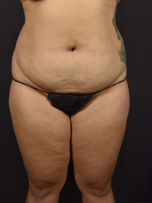 Tummy Tuck before photo