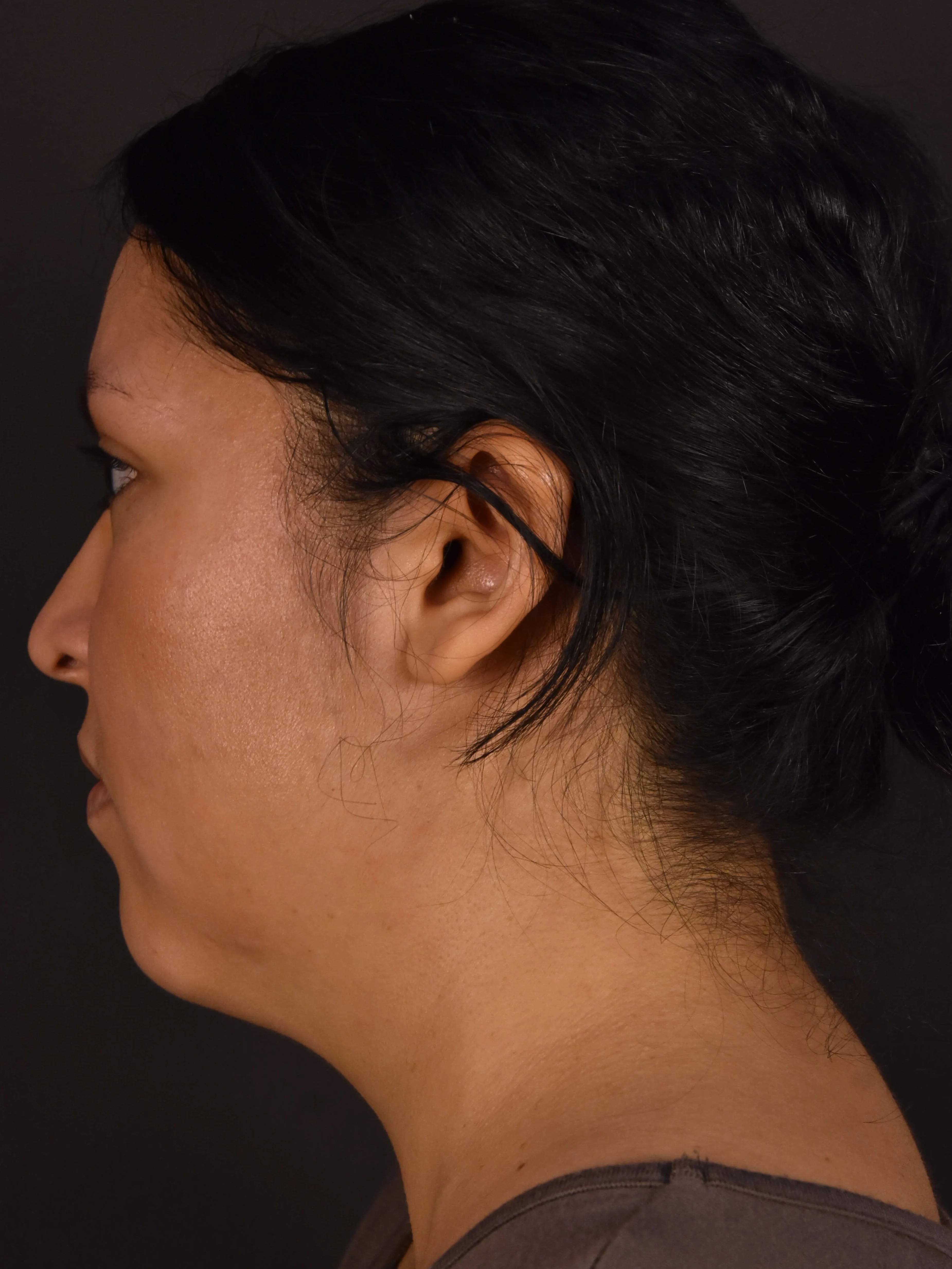 Procedure result at Plastic Surgery Vegas