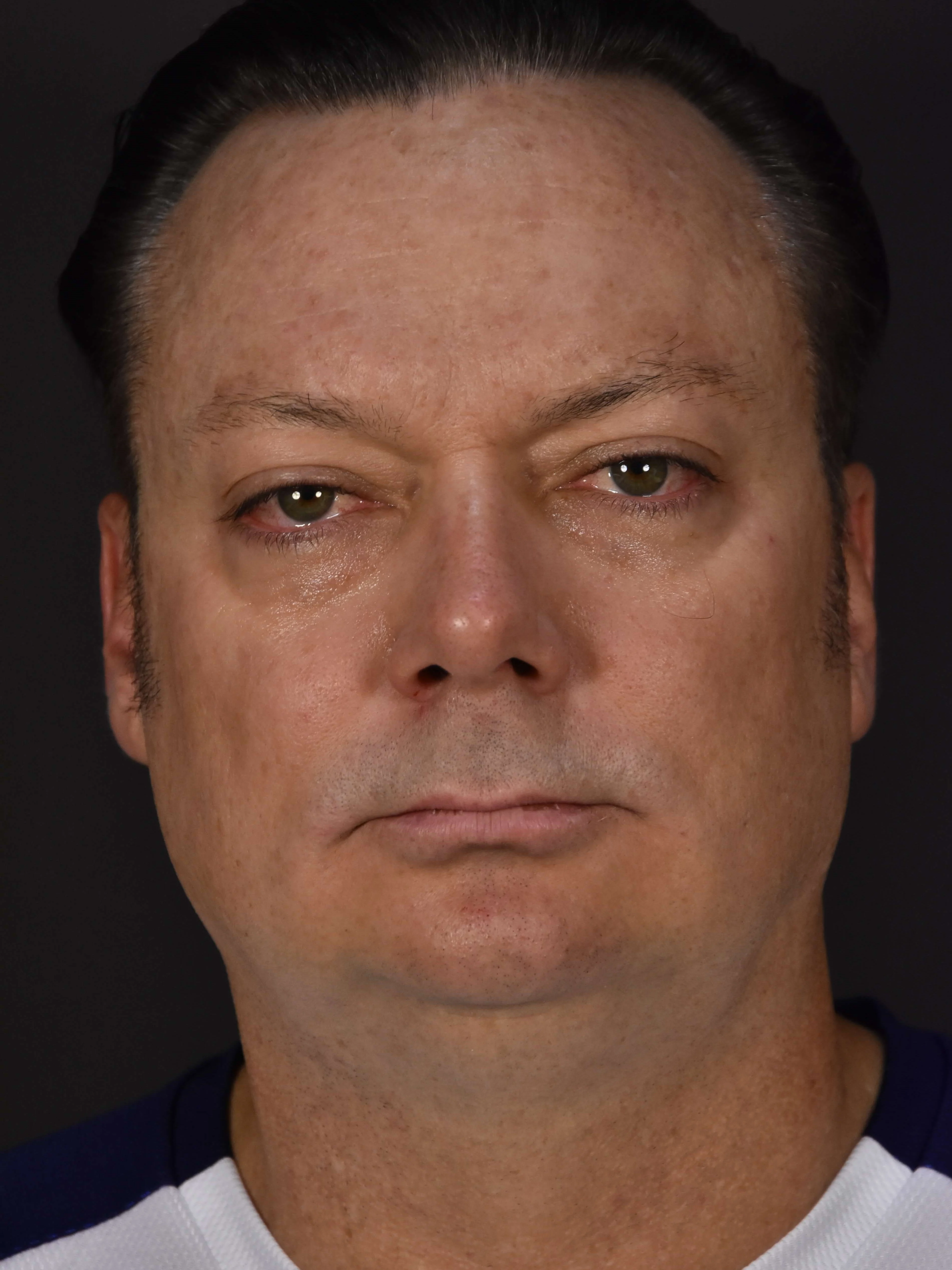 Procedure result at Plastic Surgery Vegas