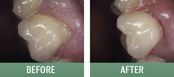 The Sugar House Dentist dental veneers result
