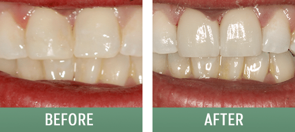The Sugar House Dentist veneers after — Salt Lake City, UT
