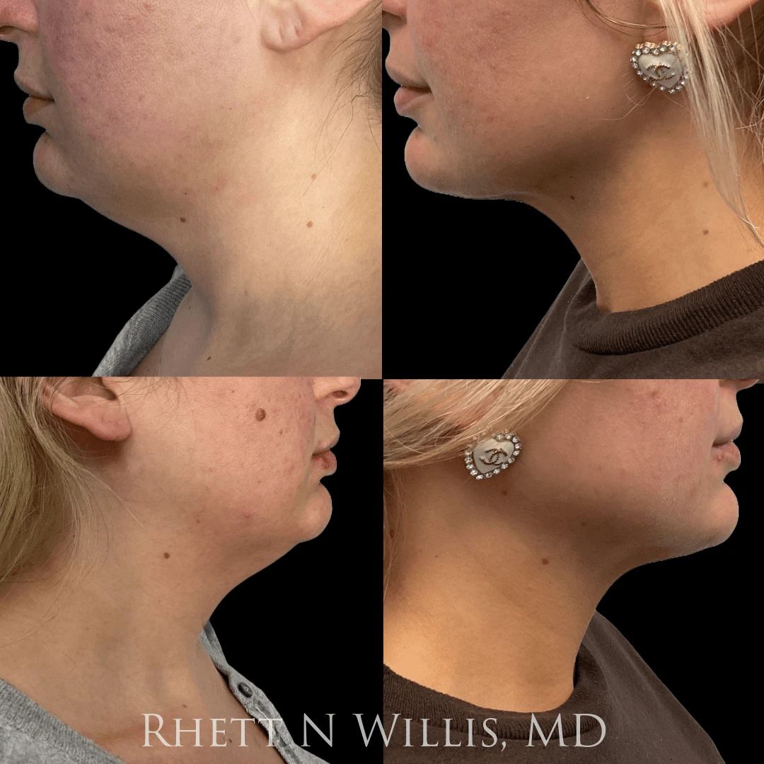 A result from Utah Cosmetic Surgery