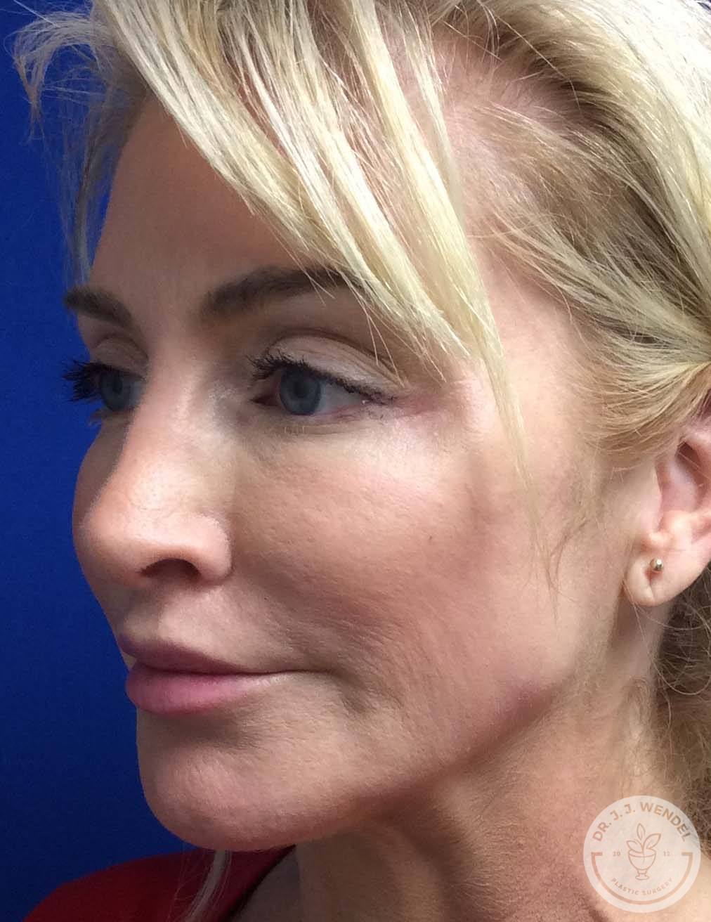 A result from SKINHAUS Beauty